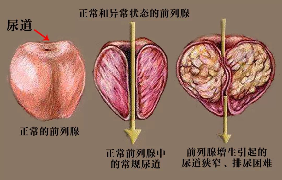 绿激光前列腺增生患者的福音