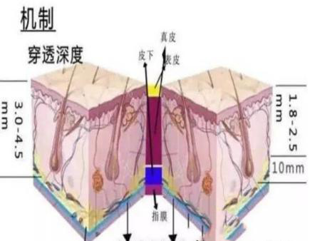 美容超声刀原理是什么_白带是什么图片(2)