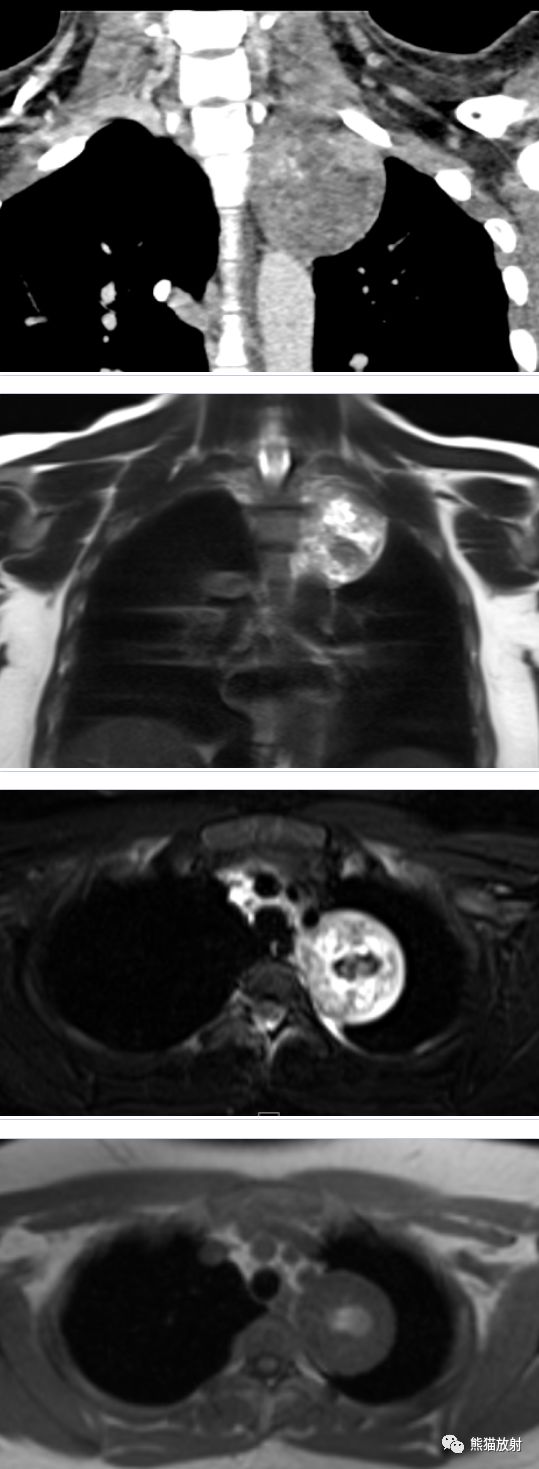 纵隔实性肿物之[神经鞘瘤]丨小打卡读片精选(23)