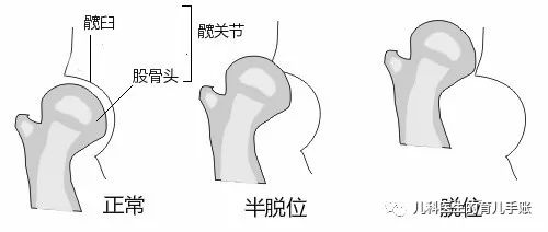 什么是先天性髋关节发育不良?| 儿疾科普