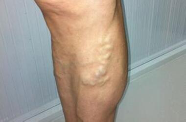 腿酸不用管?当心致命筋瘤找上你!一号难求的