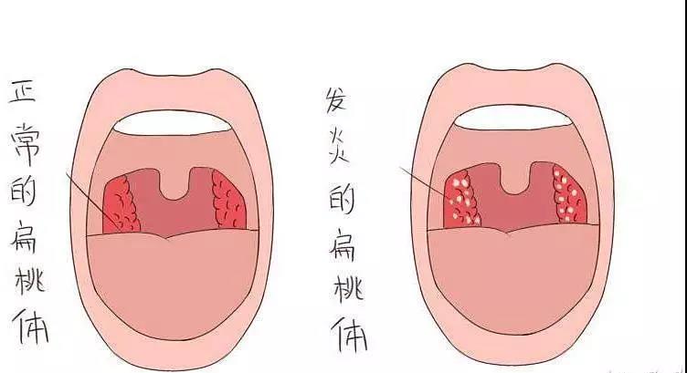 当扁桃体发炎时,就会充血红肿,有时还会出现黄或白色脓点,或灰白色