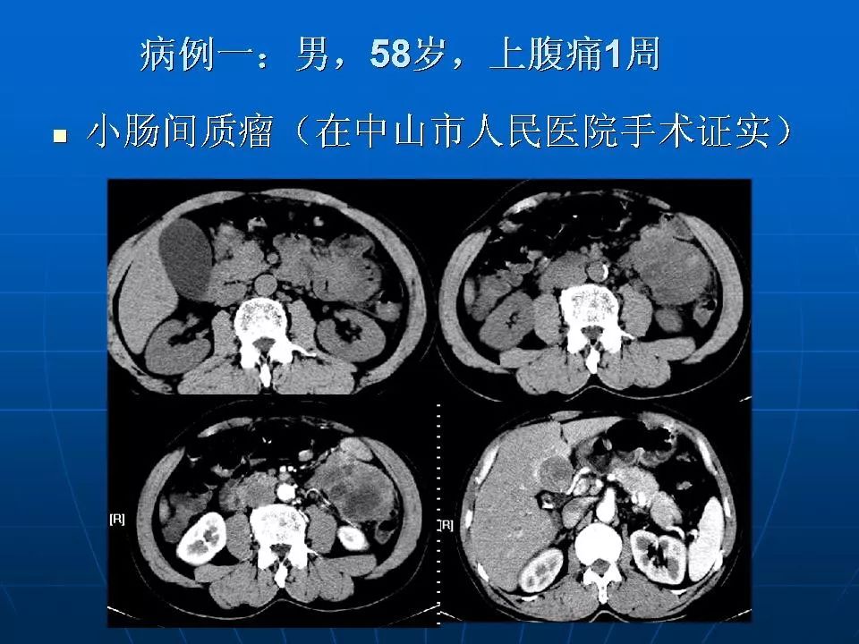 胃肠道间质瘤的ct诊断丨影像天地