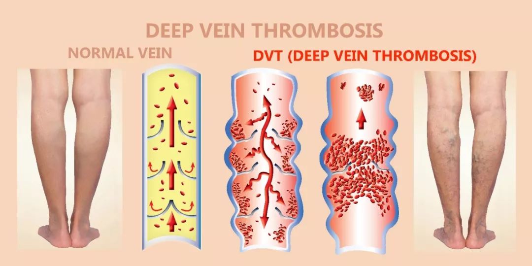 有血栓的人口比例_腿上有血栓真人图片