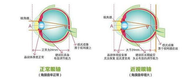 眼睛近视是因为眼轴变长,来自远处点的光会聚在视网膜前,看不清远处的