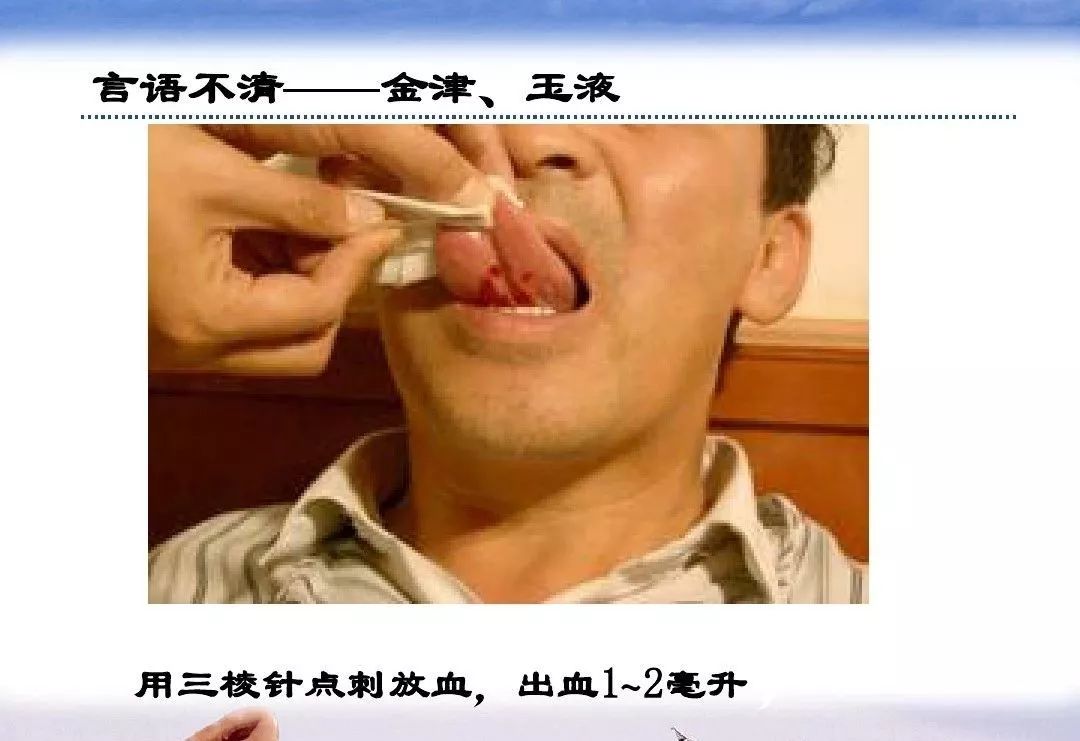 针灸治疗中风临床讲解