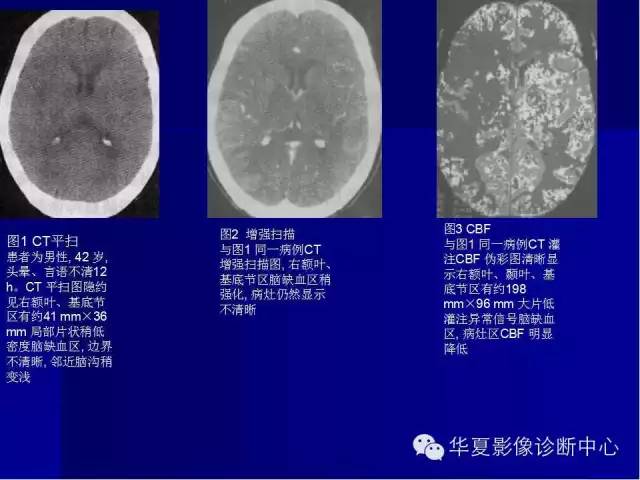 一文搞懂ct脑灌注成像