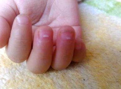                     孩子身上有这6个特征，说明“锌不足”，补锌和补钙一样重要