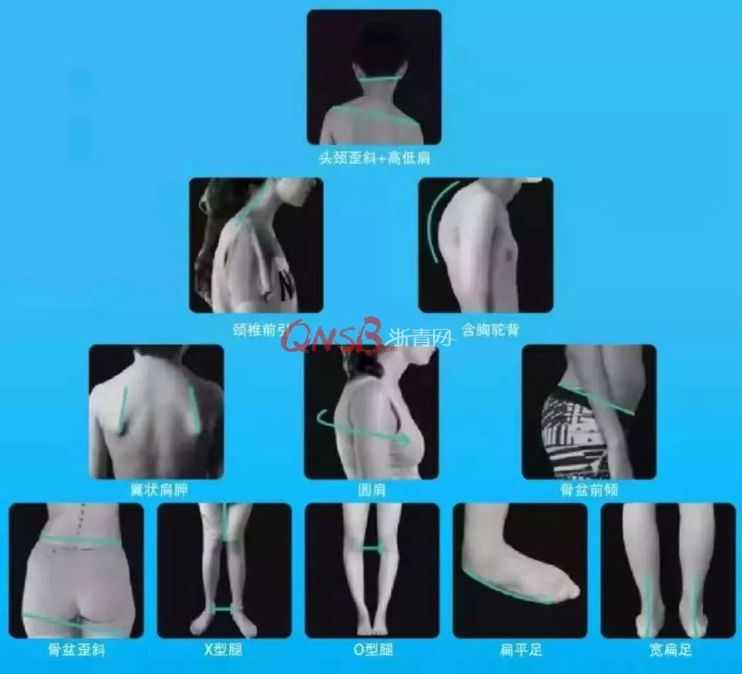                     妈妈急疯！暑假过完杭州10岁男孩突然站不直了！医生：现代孩子十有八九有这问题！