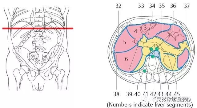 层1,肝右叶;2,肝尾状叶;3,下腔静脉;4,肝门静脉;5,腹直肌;6,肝圆韧带