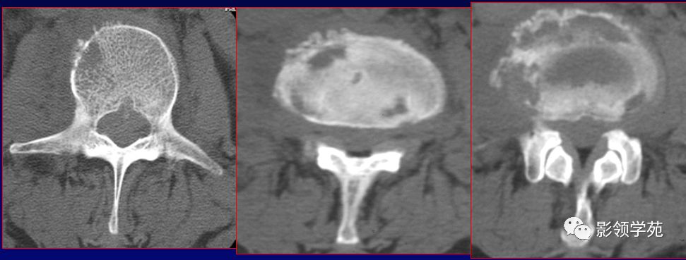 脊柱结核骨质破坏(ct图1)脊柱结核(ct图)了解脓肿位置及大小,与周围