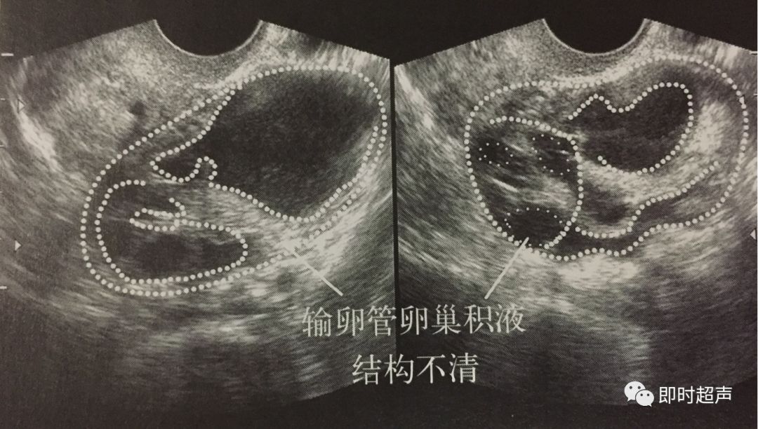 输卵管炎性疾病超声诊断