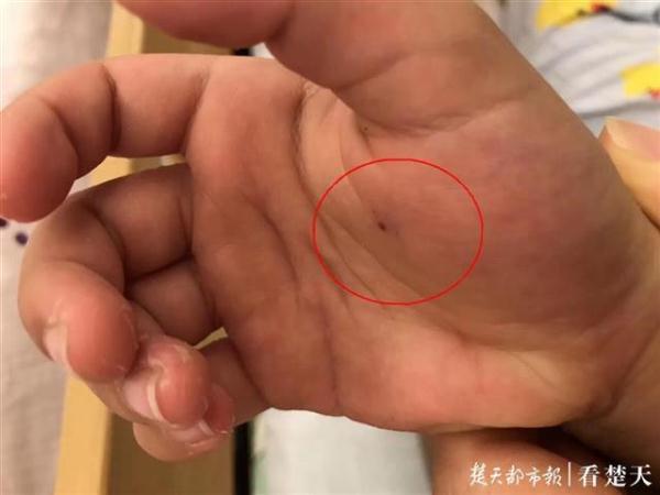                     男童被马蜂蜇伤，护士妈妈巧用母乳“解毒”