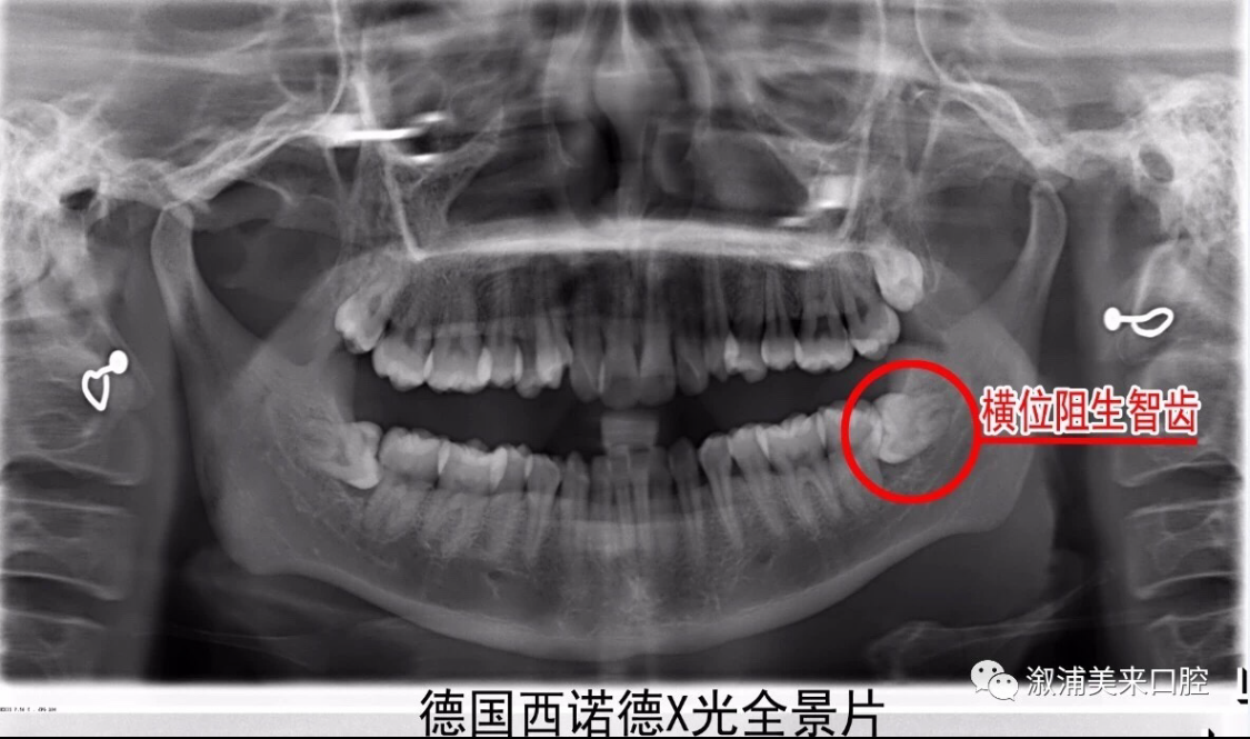 为什么要拔智齿?这组与牙医的对话告诉你!