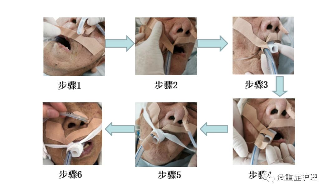 有图有真相,手把手教您气管插管固定新方式!