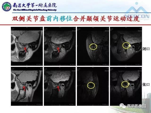 推荐| 颞颌关节紊乱的mri诊断