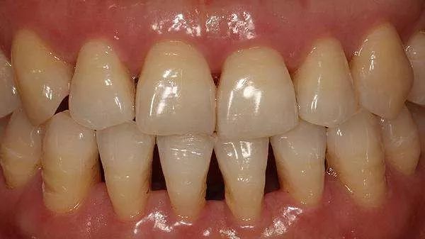三角的产生主要是由于牙齿清洁不到位,继而产生了菌斑,牙结石,让牙龈