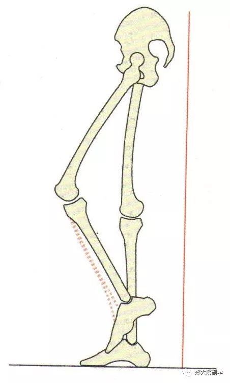 下肢肌力失衡造成姿势和步态异常