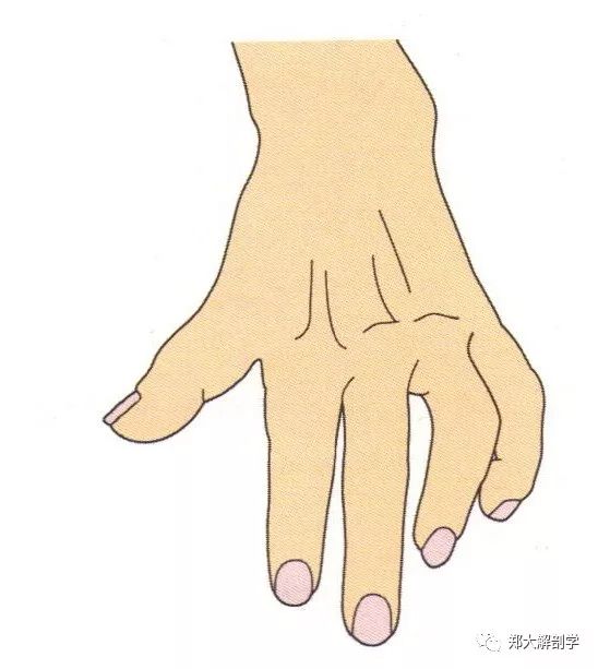 尺神经麻痹爪形手尺神经麻痹通常由尺神经沟处的直接外伤或压迫所
