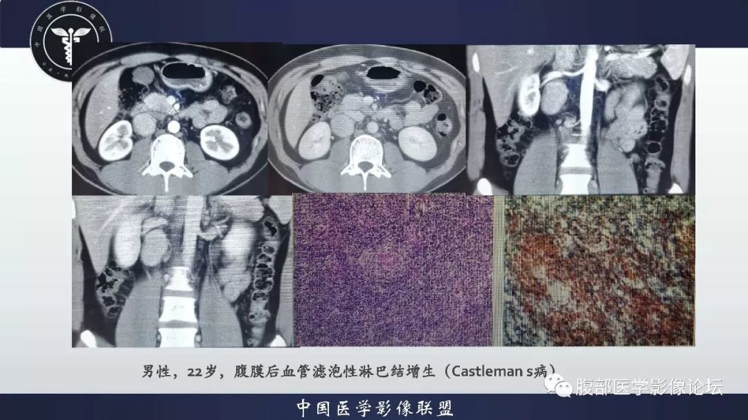 内部为脂肪组织,腰交感神经干,乳糜池和淋巴结等,无脏器结构