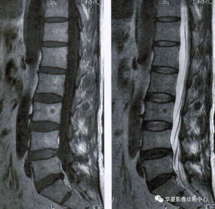 影像基础椎体骨髓两种类型退变的影像表现