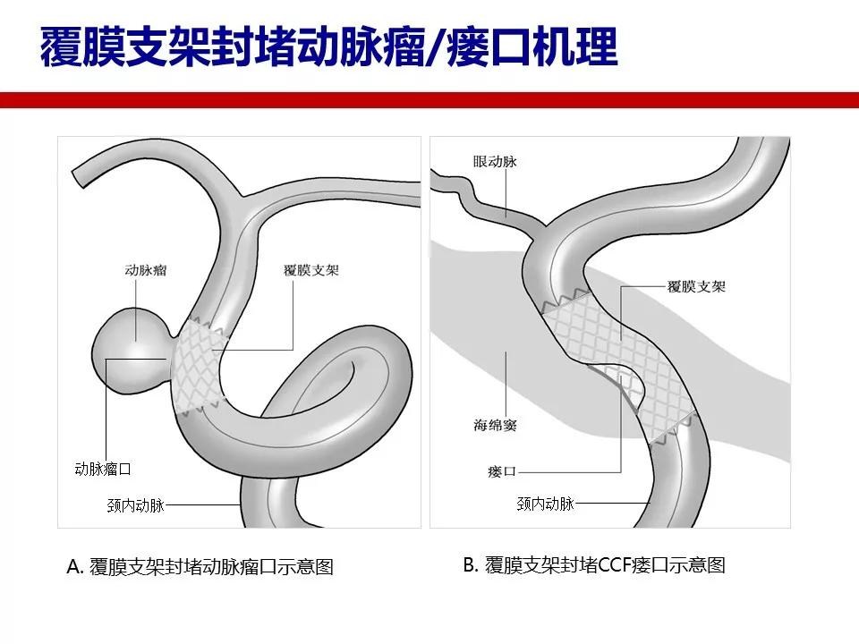 李明华教授willis颅内覆膜支架临床应用问题探讨