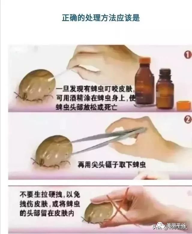 致命蜱虫该如何防护:顺义区医院收治一名蜱虫咬伤患者