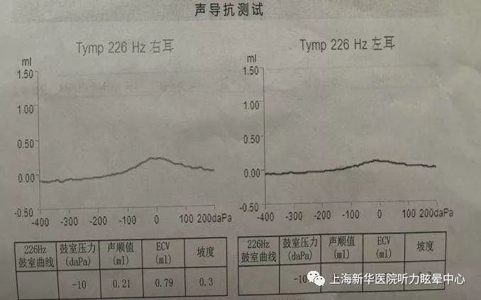 dpoae提示:双耳均未通过.声导抗(2019-05-13)提示:双耳as型.