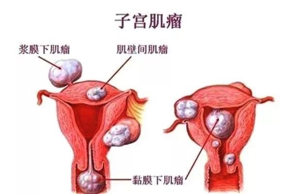 当一些备孕女性或者孕妈妈查出患有子宫肌瘤后,变得非常紧张,会不会