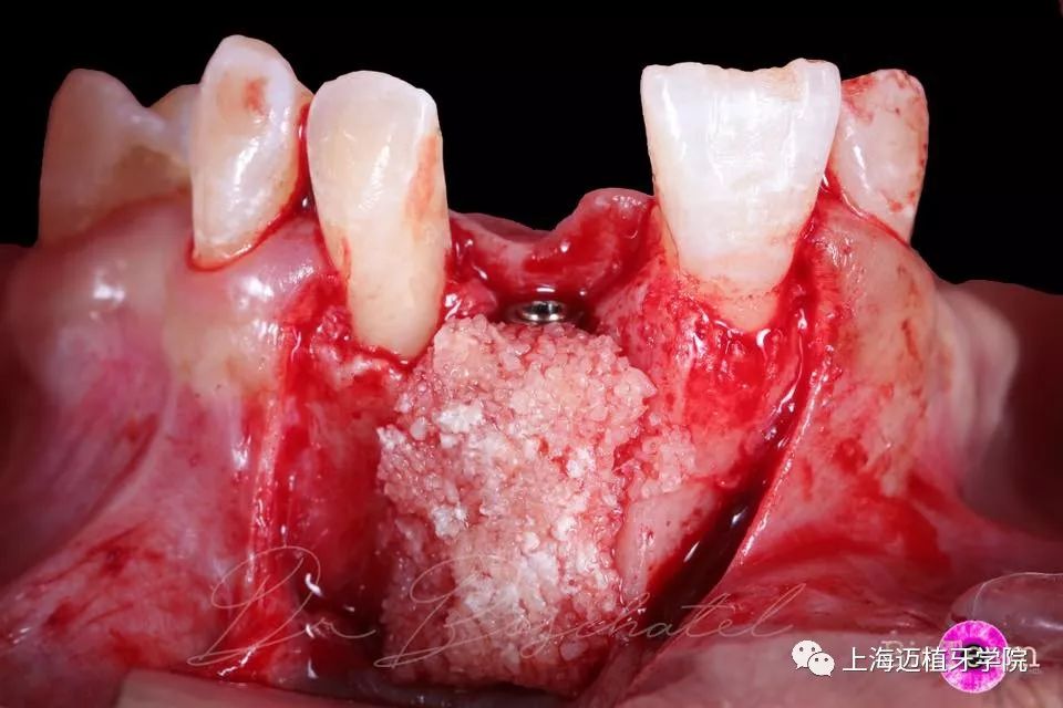 前牙区严重骨缺损gbr病例_骨粉