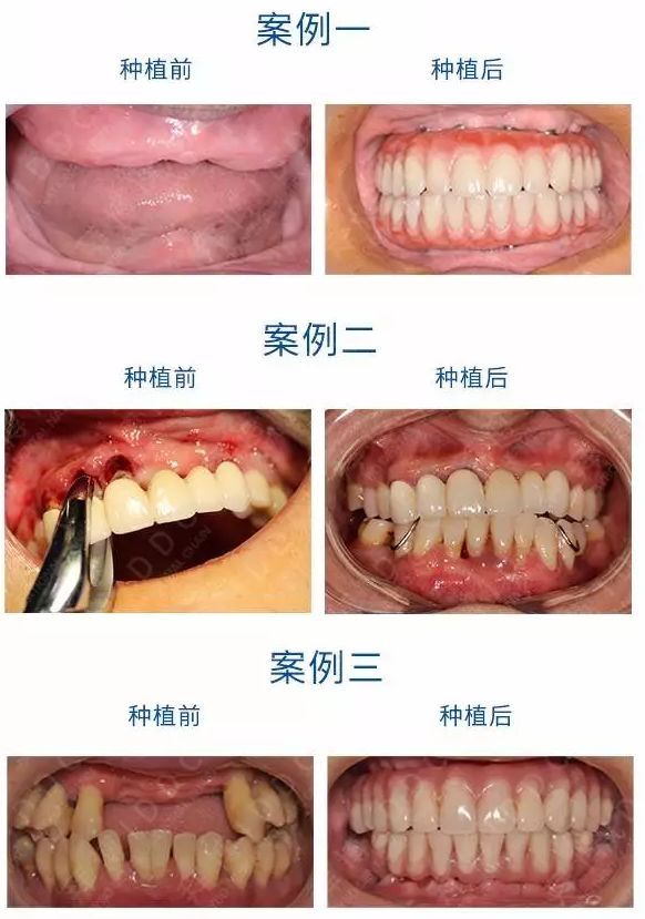 人口种植牙好吗_半口种植牙成活率高吗(3)