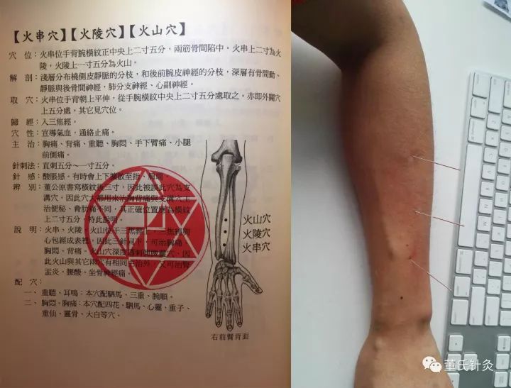 董氏奇穴: 抑郁症治疗_针刺