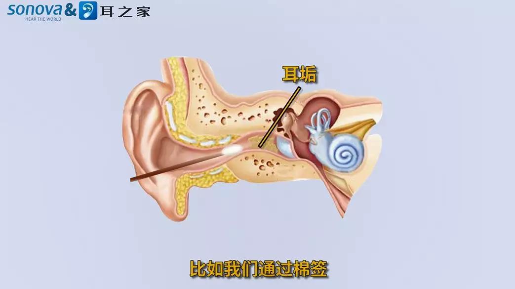 就会在耳道内堆积,逐渐将耳道堵住产生耵聍栓塞.