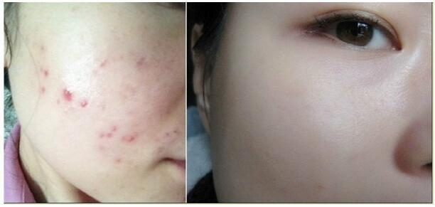 怎么做才能消除痘痘 b76d3382ea6c4029b3e0b633b06ae990.png