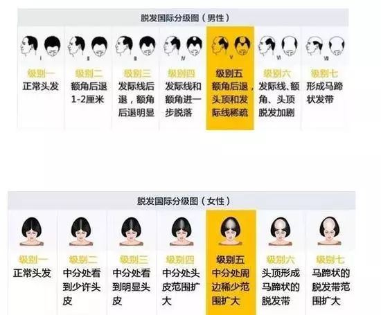 脱发人群超2.5亿 每6人中有1人脱发 如何不当"光头强"