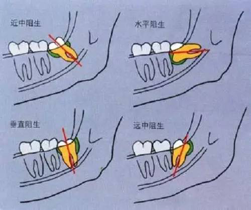 拔了智齿口水多怎么办