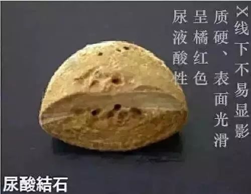 草酸钙结石的硬度较高;磷酸钙结石则是一种灰色至白色,质脆易碎,表面