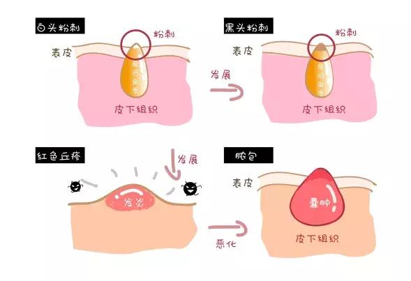 皮肤闭口怎么办