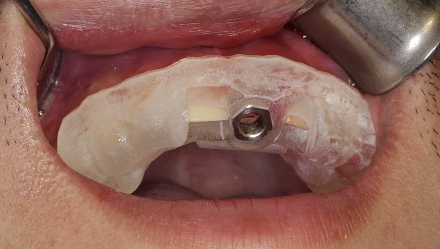 3在implantguide全程手术导板引导下逐级扩孔,直至完成种植孔最终