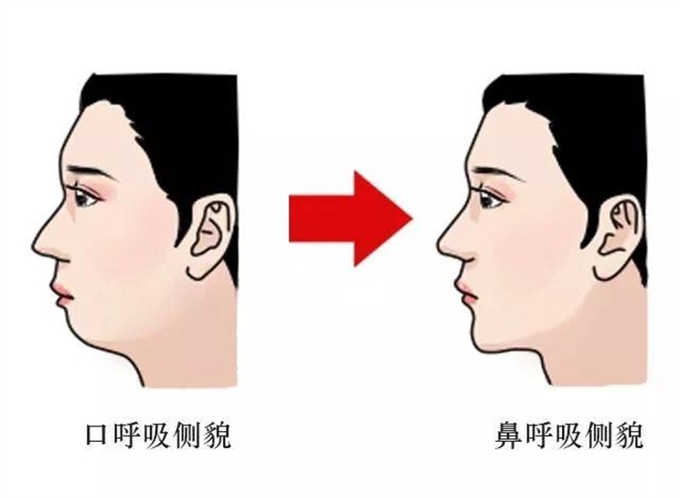 口呼吸是指睡觉或者运动时用嘴巴呼吸 我们正常呼吸是通过鼻腔完成的