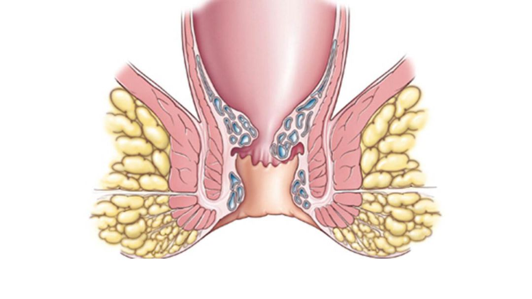 这就是瘘管,瘘管的内口在肛门里头,外口在肛门旁边的皮肤上,统称为瘘