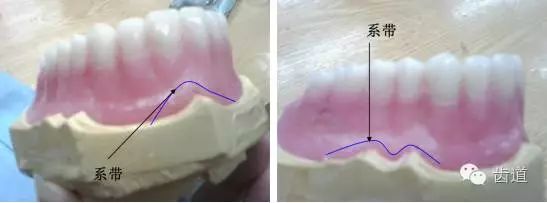 图说全口义齿蜡型及龈沟修整要点
