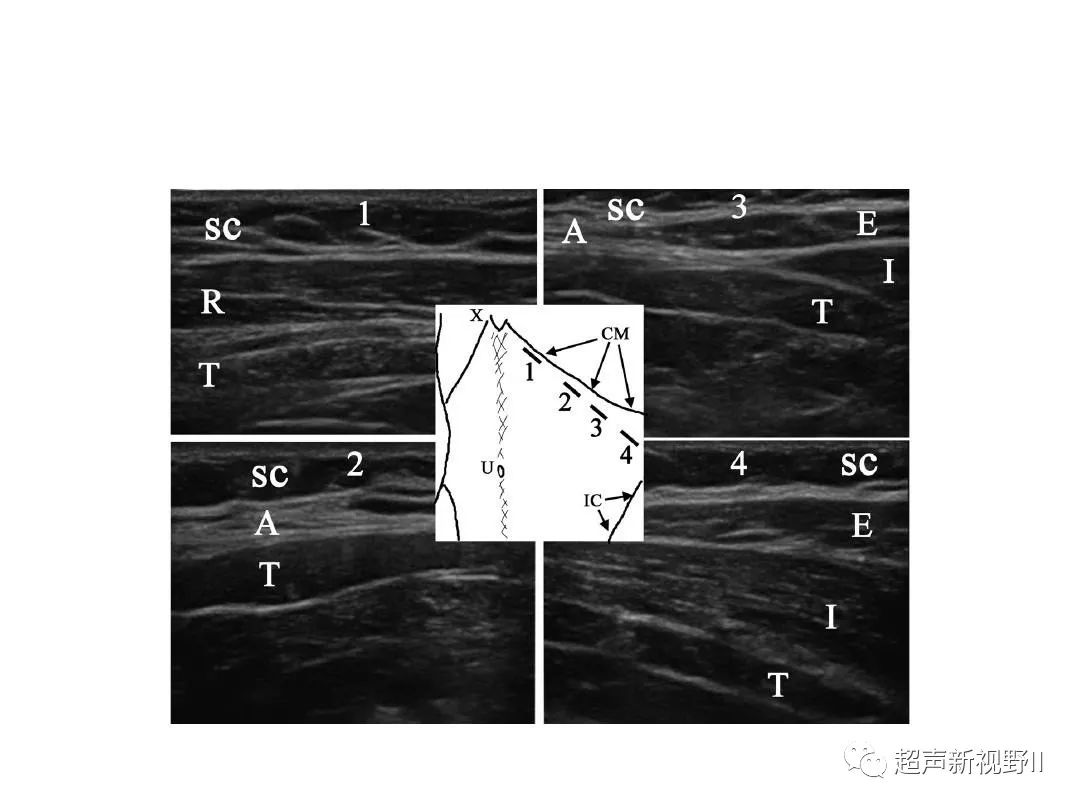 精彩课件 | 超声引导腰方肌阻滞