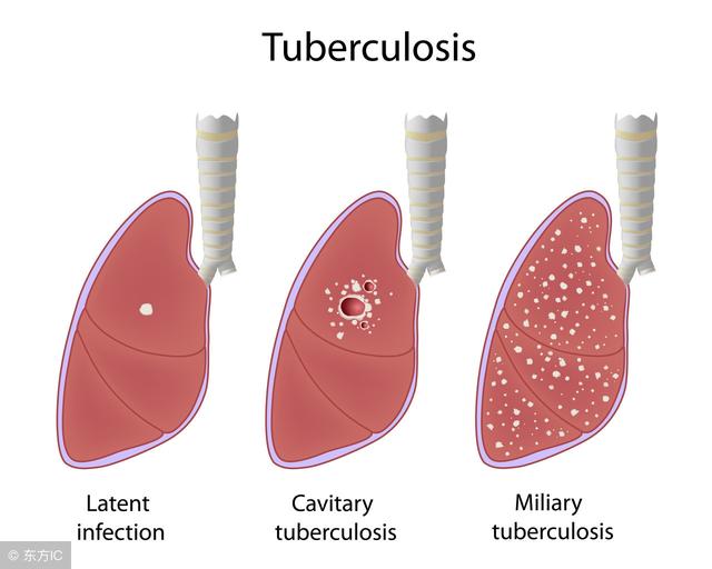 如何预防肺部小结节 8b480b377e42423185cf7197c47c8f5f.jpeg