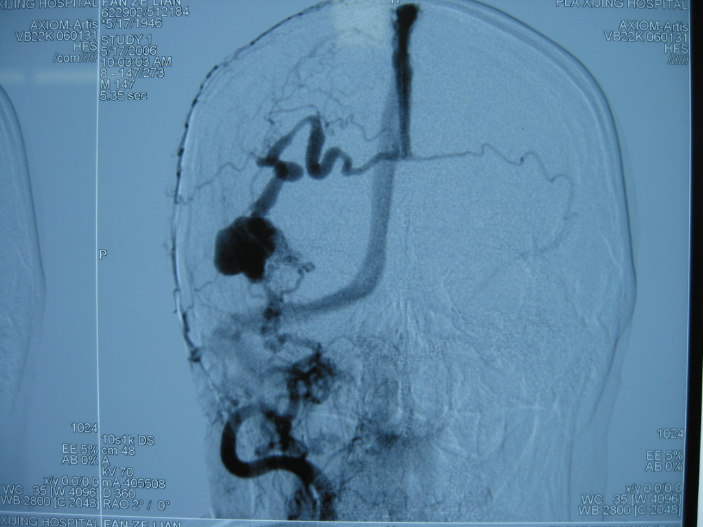 贺晓生教授脑内巨大动静脉畸形(avm)ct&mri影像展示