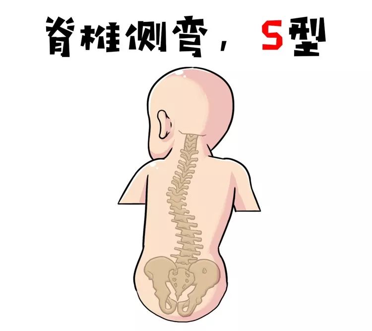 脊椎侧弯是不可逆的过程左翘造成的伤害并不能通过右翘来抵消只会造成