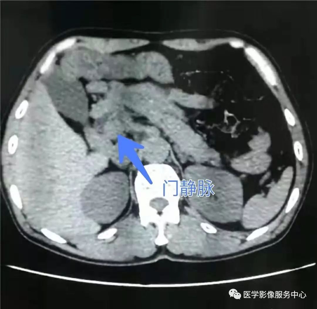 图22-17 经肠系膜上动脉的CT横断层图像-外科学-医学