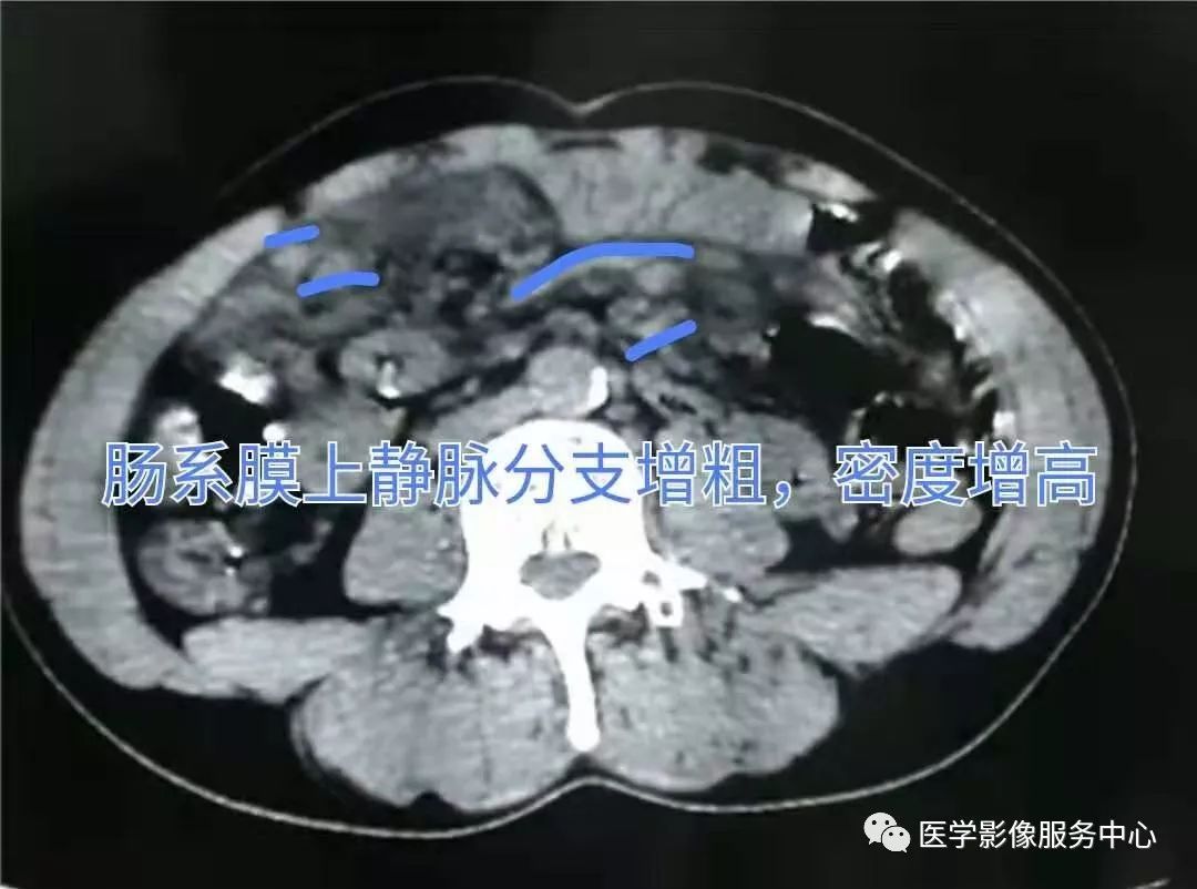 手把手教你 | 平扫ct如何诊断肠系膜静脉血栓