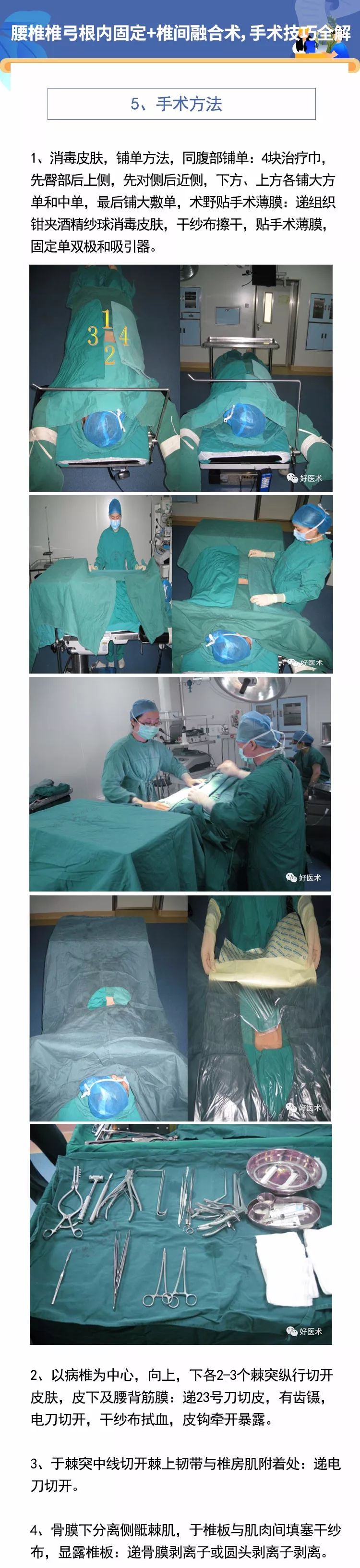 弓根钉内固定术是治疗腰椎间盘突出,腰椎不稳,腰椎滑脱的常用手术路径