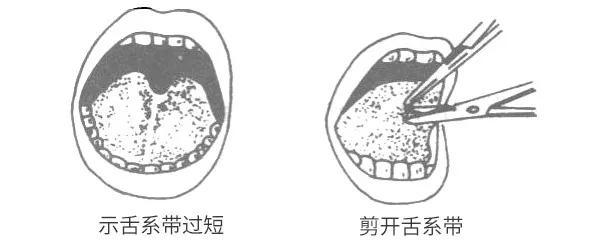 新生儿舌系带短怎么办